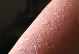 sun burn